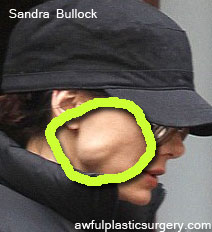 Sandra Bullock Plastic Surgery on Sandra Bullock Thread Lift